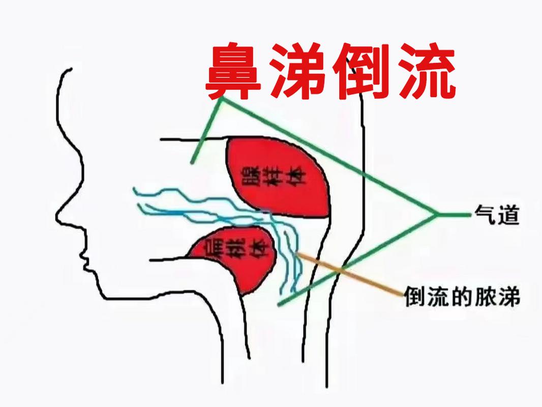 鼻后滴漏综合征