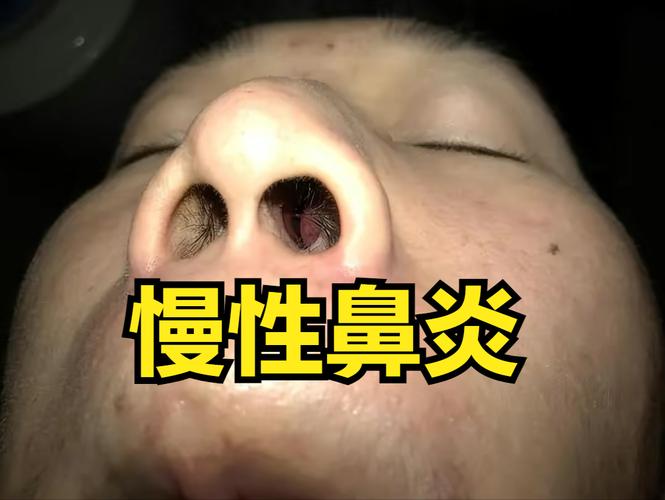 慢性鼻炎