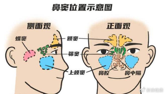 鼻窦炎