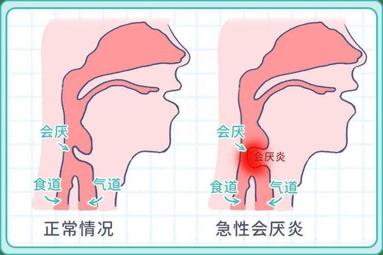 咽部疼痛