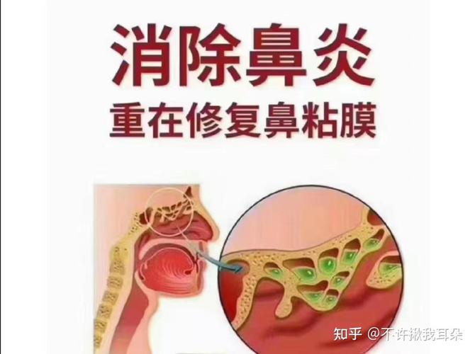 省立医院鼻炎治疗效果如何？