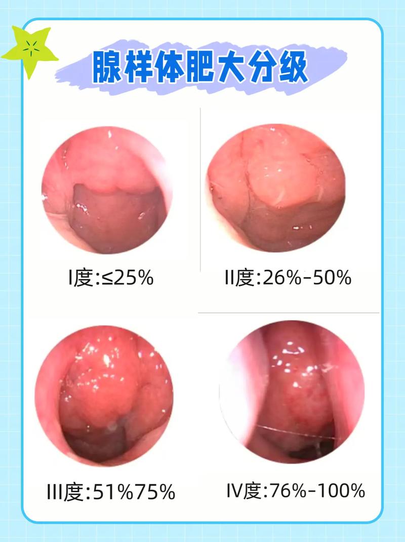 鼻炎腺样体增生