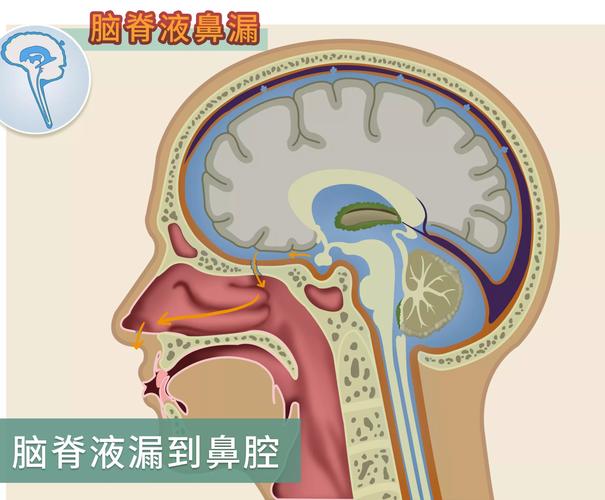 脑脊液鼻漏