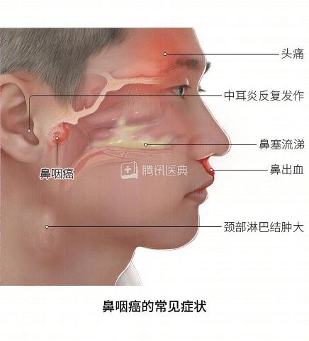 有鼻炎的人能接触甲醇吗？安全性分析