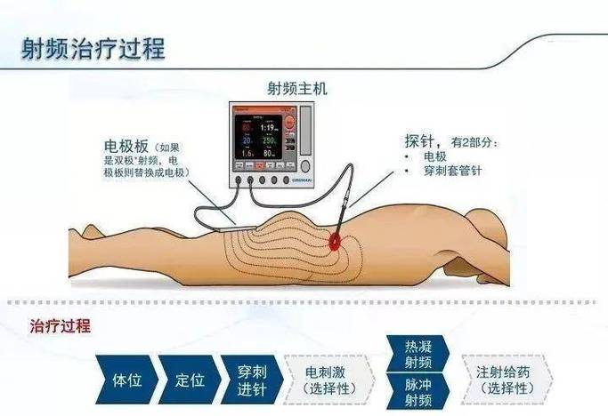 脉冲治疗