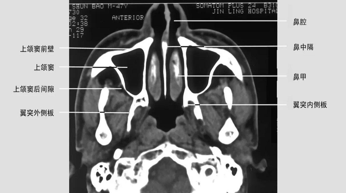 鼻窦 CT