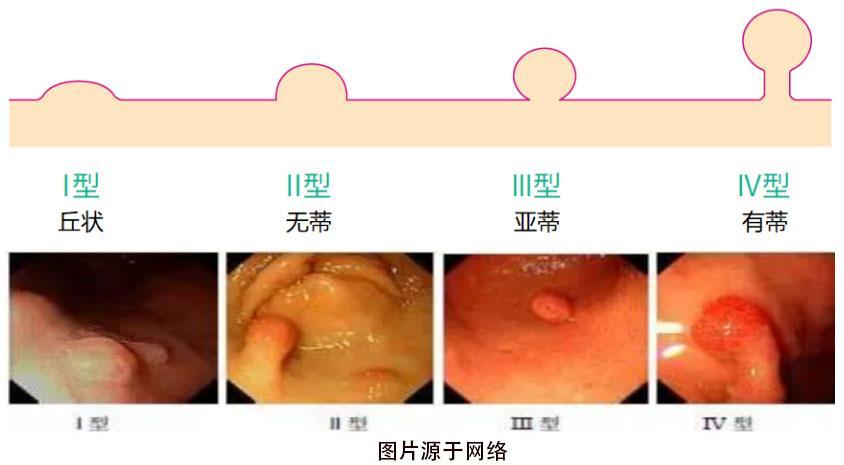 癌症判断