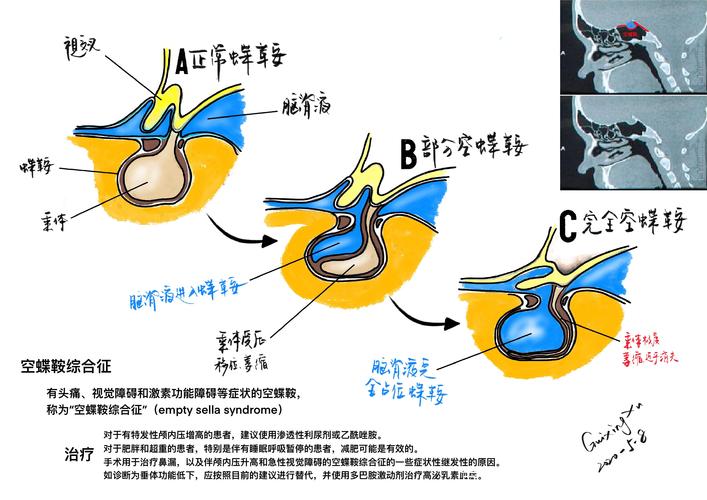 空蝶鞍