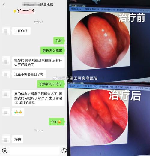 肥厚性鼻炎