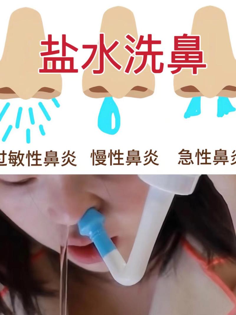 盐水洗鼻：慢性鼻炎患者的福音吗？