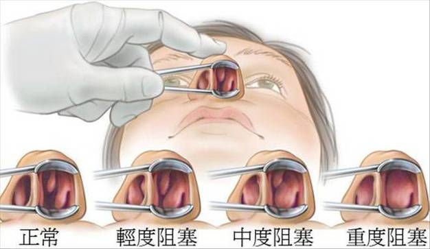 过敏性鼻炎如何影响我们的外貌形象？