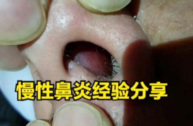 苦蒜疗效解密：真的可以根治鼻炎吗？