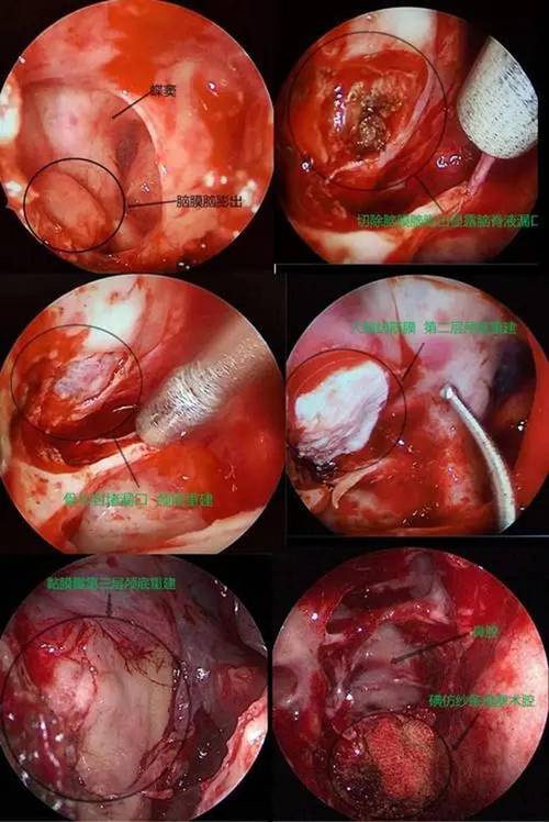 鼻内镜手术