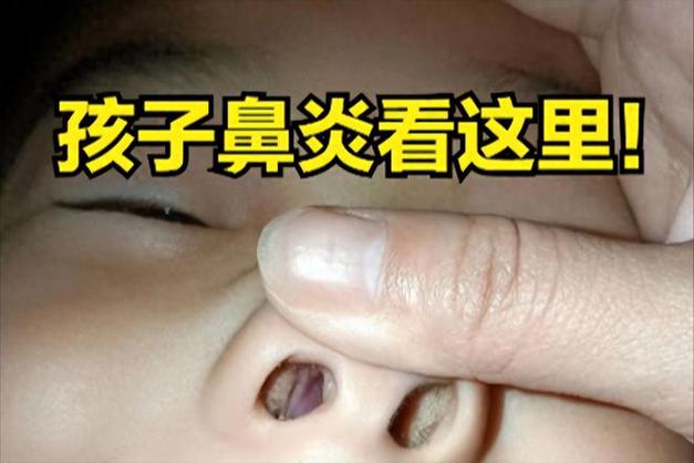 孩子鼻炎治疗方法：如何改善症状？