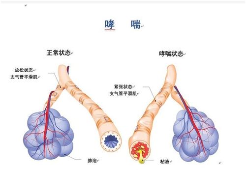 呼吸道高反应性